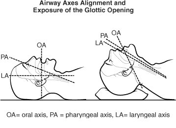 Schéma comparant l'alignement des axes oral, pharyngé et laryngé sans et avec position de reniflement