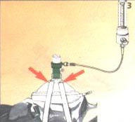 Étape 3 : positionnement du masque sur le visage du patient
